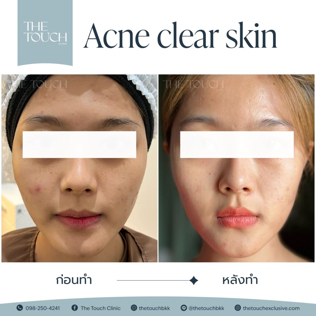 review-acne-clear-skin
