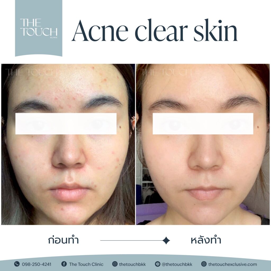 review-acne-clear-skin