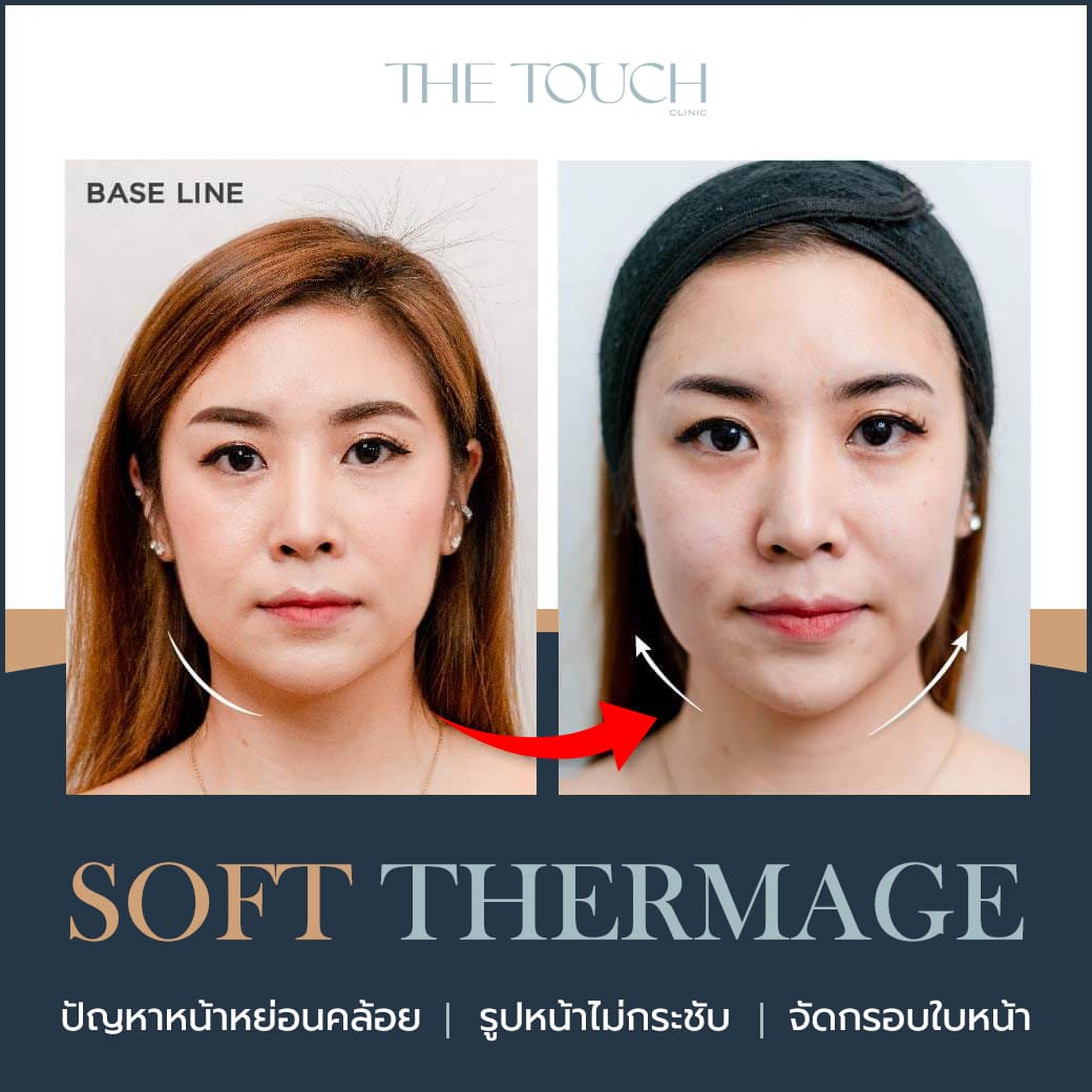Review Soft Thermage คุณฝน