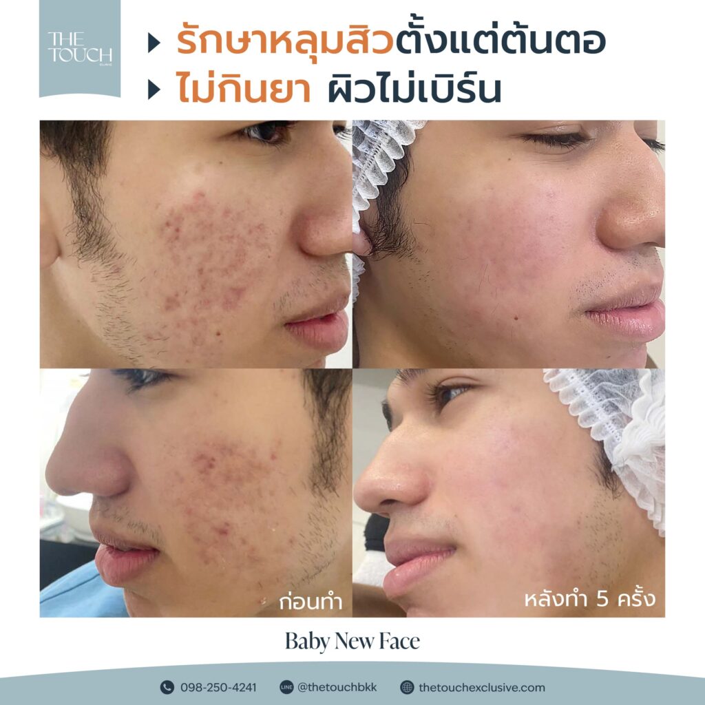 review before after babynewface
