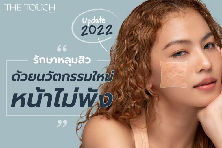 รักษาหลุมสิว ด้วยนวัตกรรมใหม่ หน้าไม่พัง อัปเดต 2022