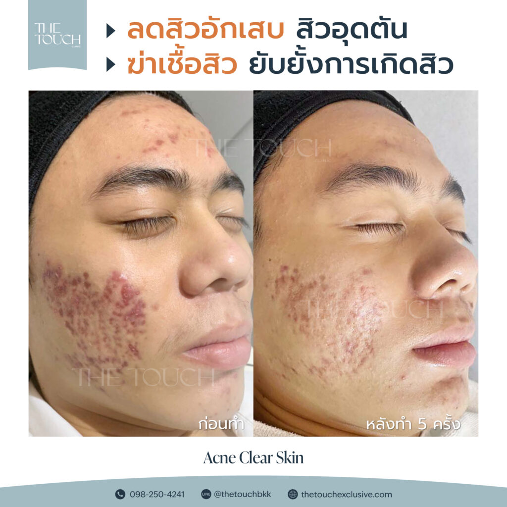 review-acne-clear-skin