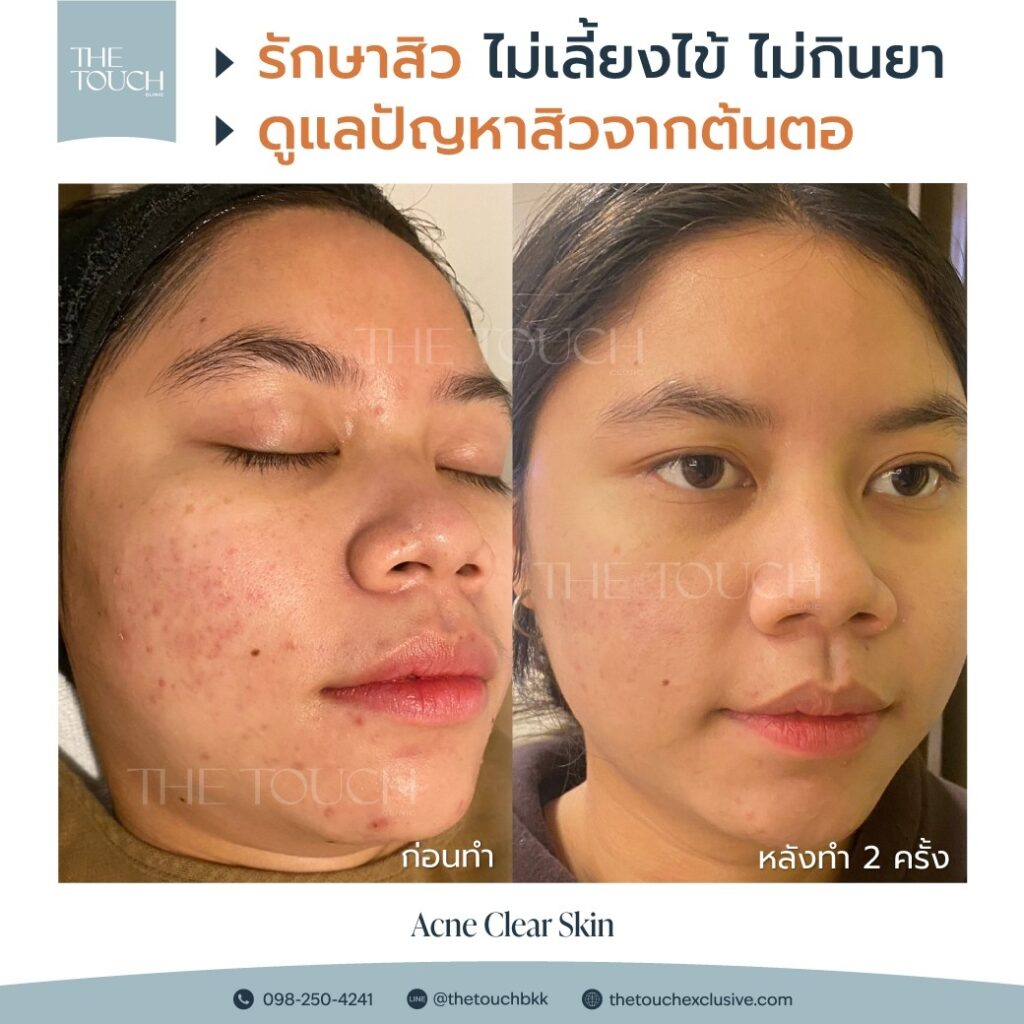 review-rf-eye-lifting
