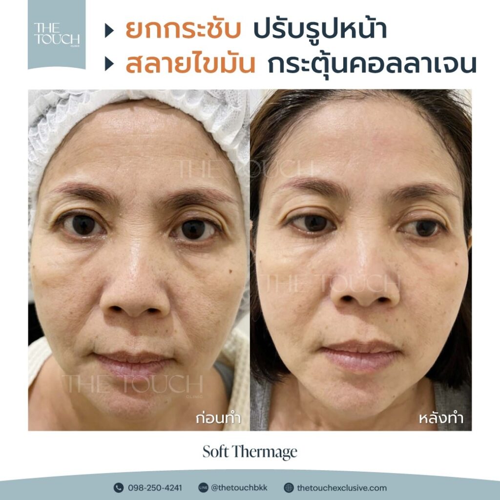review-soft-thermage