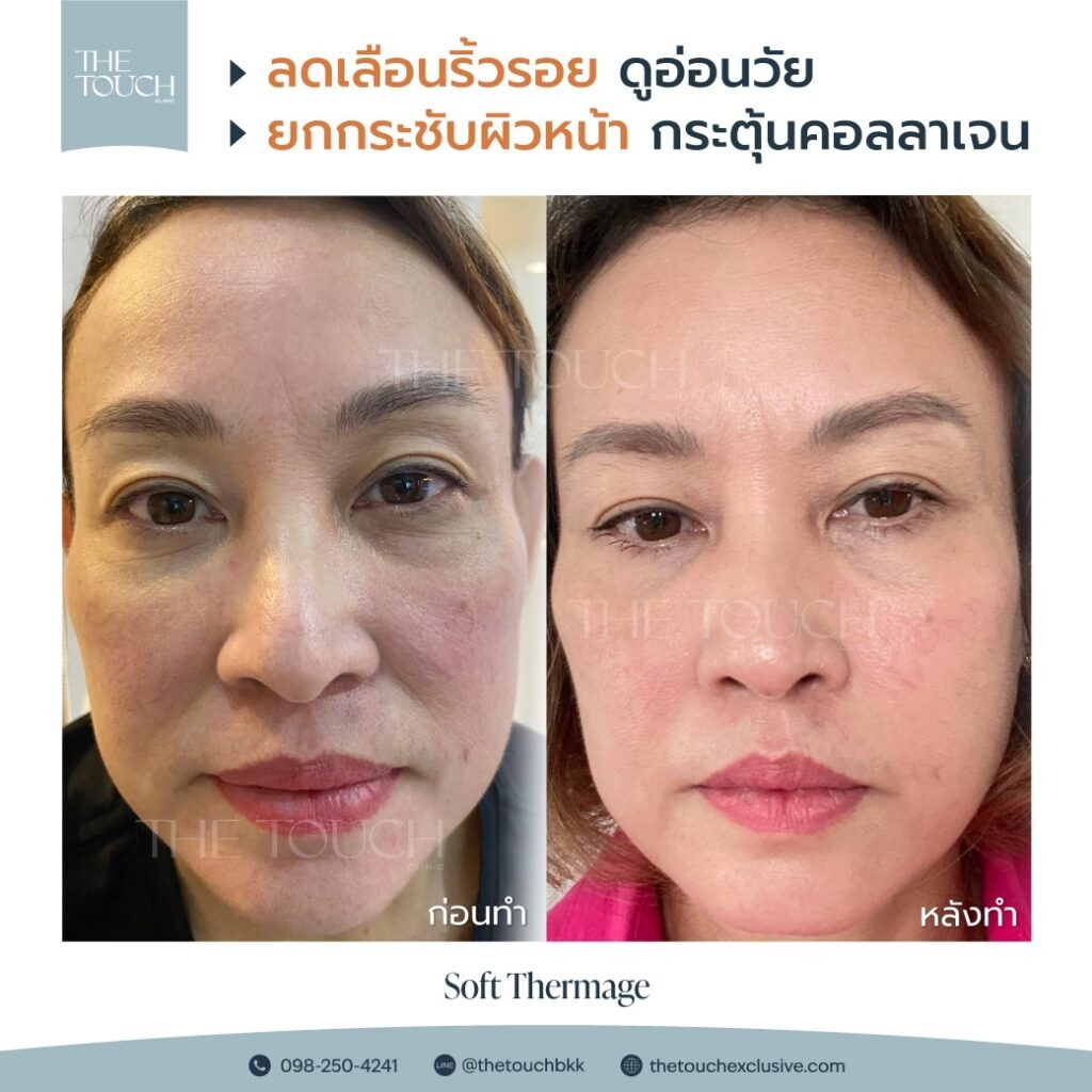 review-soft-thermage