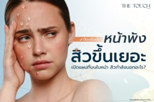 สิวอักเสบเยอะขึ้นไม่หยุด ตำแหน่งสิวบอกปัญหา พร้อมวิธีรักษาไม่กี่ขั้นตอน