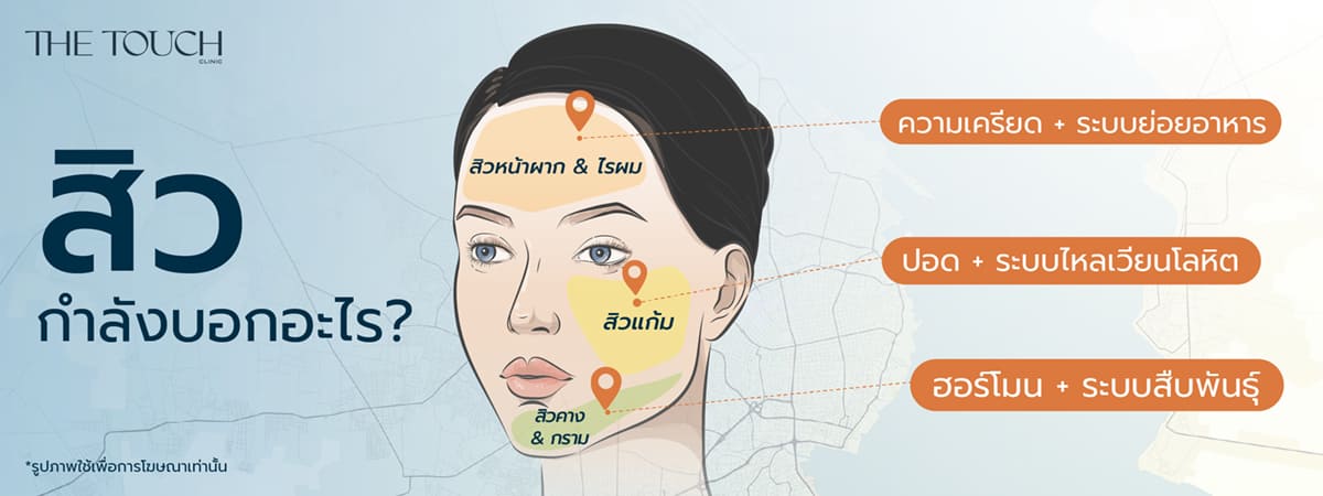 สิวอักเสบ