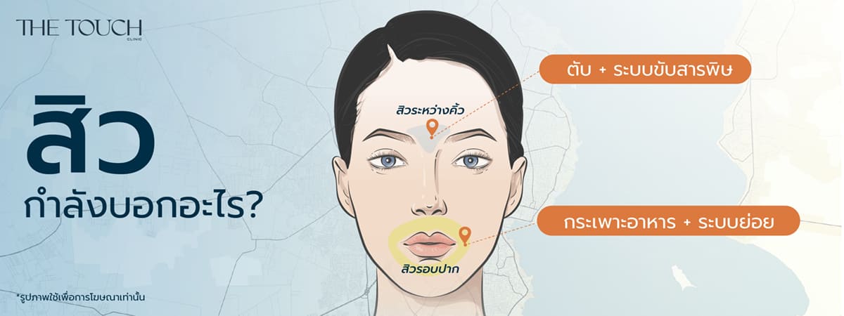 สิวอักเสบ