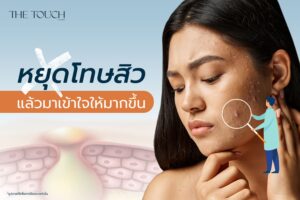 หยุดโทษสิว แล้วมาเข้าใจให้มากขึ้น