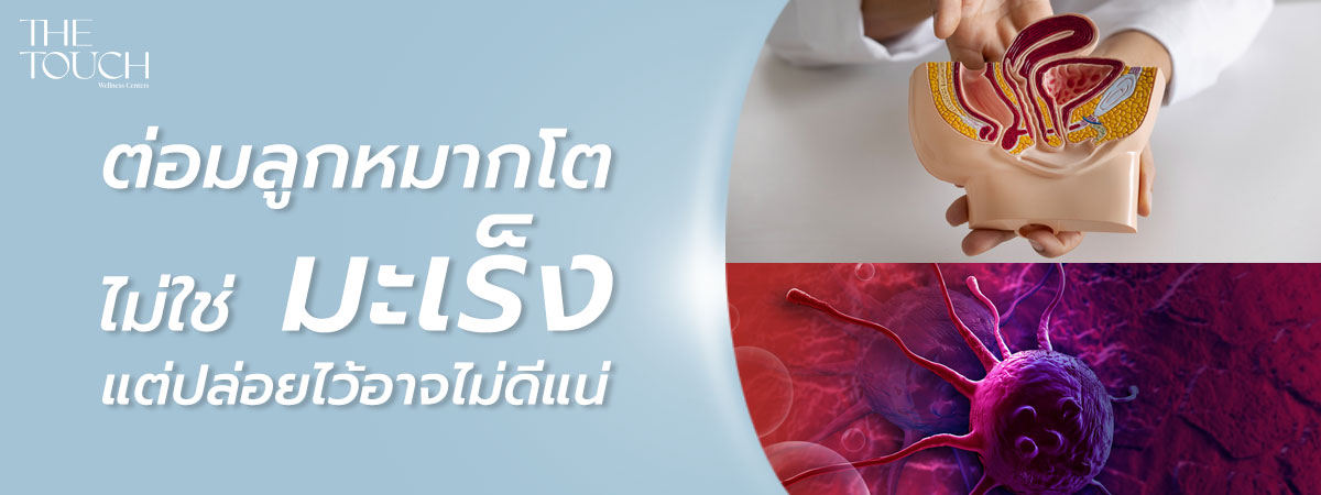 ต่อมลูกหมากโต