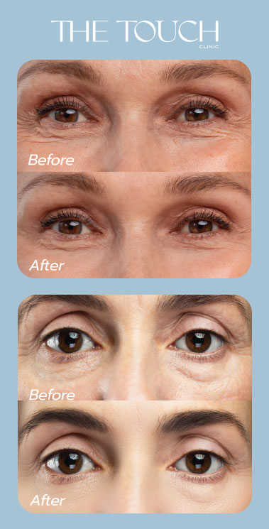 ผิวเรียบเนียน