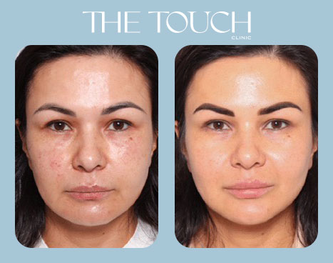 ลดริ้วรอย