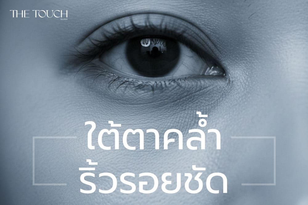 ใต้ตาคล้ำ ริ้วรอยชัด ทำให้หน้าโทรมจริงไหม? ทางเลือกดูแลรอบดวงตาด้วยโปรแกรม RF Eye Lifting