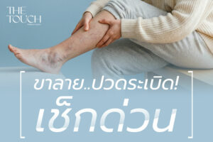 ขาลาย ไม่พอแถมปวด! เช็กสัญญาณ “เส้นเลือดขอด” เรื่องใหญ่กว่าความสวยงามที่ปล่อยไว้อาจเป็นอันตรายถึงชีวิต