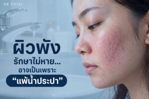 ผิวพัง ผื่นเห่อ สิวบุก อาจไม่ใช่เพราะสกินแคร์… แต่เป็นเพราะ ผิวแพ้น้ำประปา
